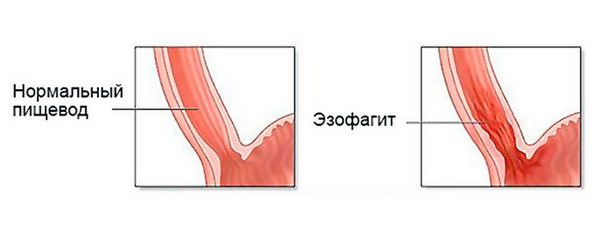 ezofagit (1).jpg