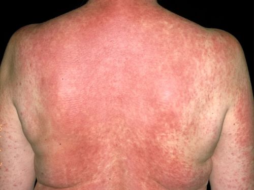 drug_allergy_news_2.jpg