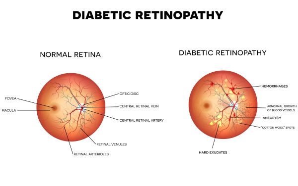 Diabetic-Retinopathy (1) (1).jpg