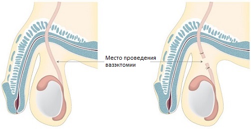 Vasectomia_1.jpg Vasectomia_1.jpg