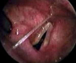 Папиллома во рту: почему появляется и как лечить