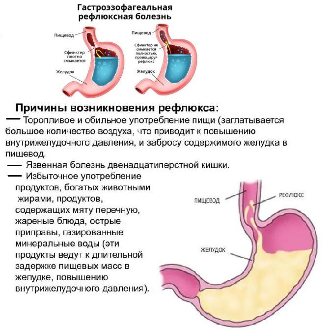 ГЭРБ - рефлюкс эзофагит. Лечение