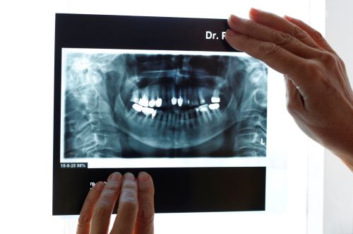 x-ray-image-of-teeth-2023-11-27-05-35-56-utc.jpg
