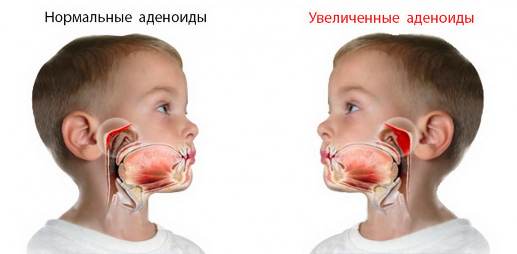 Чем лечить аденоиды у взрослых лекарства. Смотреть фото Чем лечить аденоиды у взрослых лекарства. Смотреть картинку Чем лечить аденоиды у взрослых лекарства. Картинка про Чем лечить аденоиды у взрослых лекарства. Фото Чем лечить аденоиды у взрослых лекарства