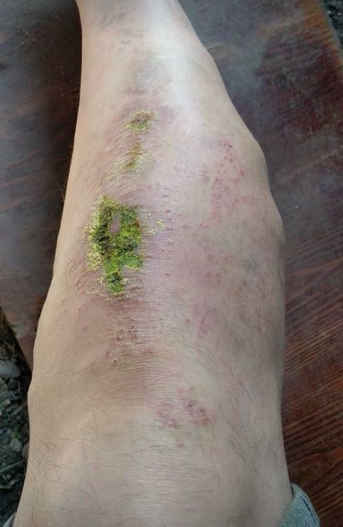 Лечение варикозного расширения подкожных вен правой нижней конечности с выраженной симптоматикой венозной недостаточности