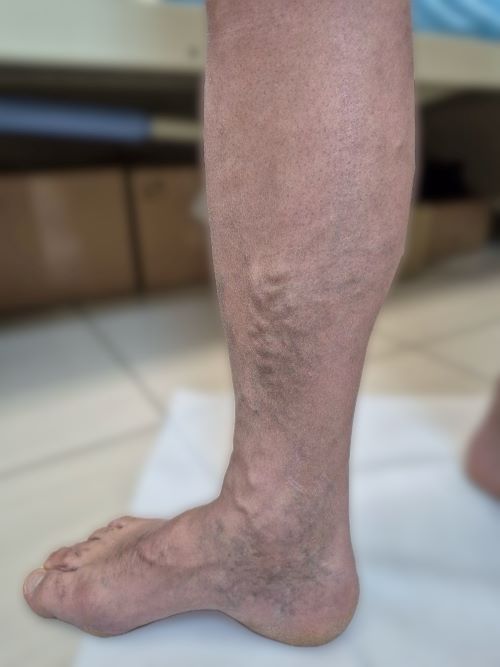 Клинический случай успешного лечения варикозного расширения вен нижних конечностей с выраженной симптоматикой венозной недостаточности